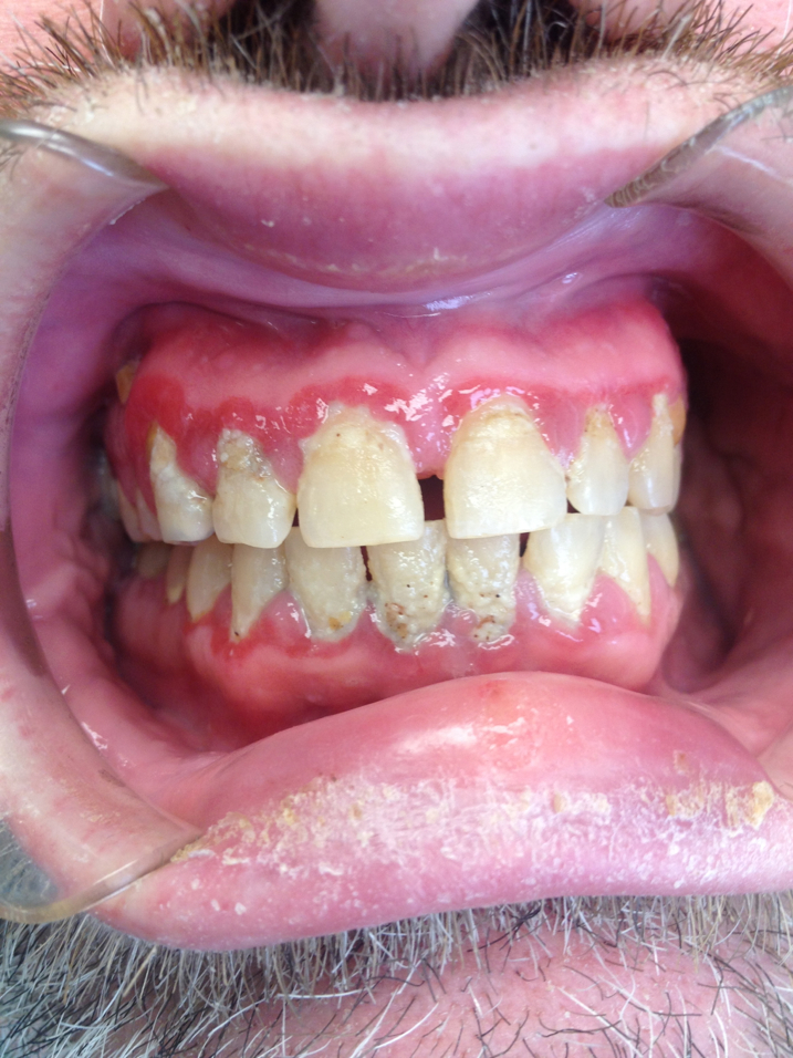 Periodontal_Gum_Disease_KC_Dentist.jpg